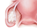 黄石卵巢囊肿